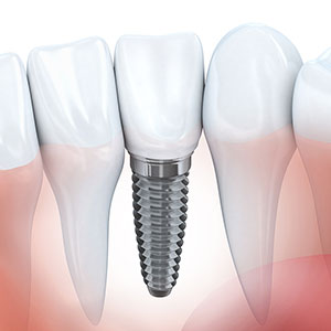 single dental implant