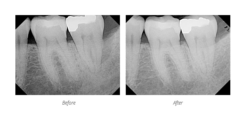 laser treatment bone regrowth