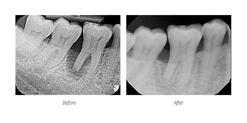 laser treatment bone regrowth