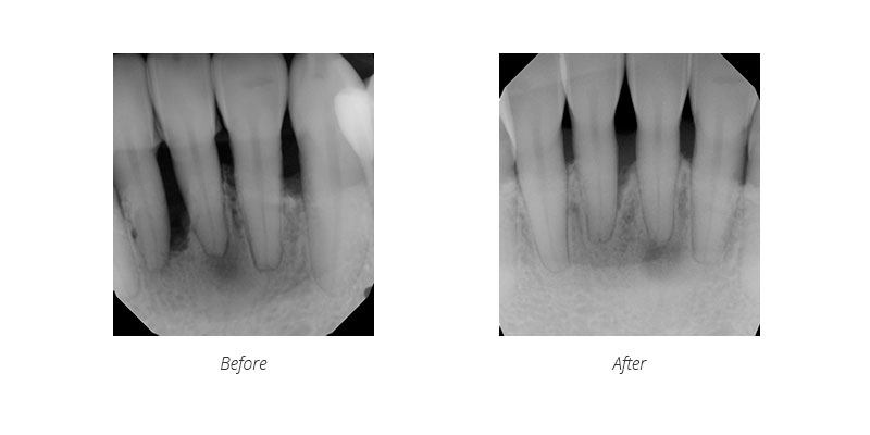 laser treatment bone regrowth