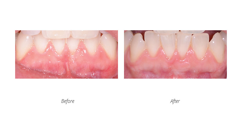 periodontal gum graft