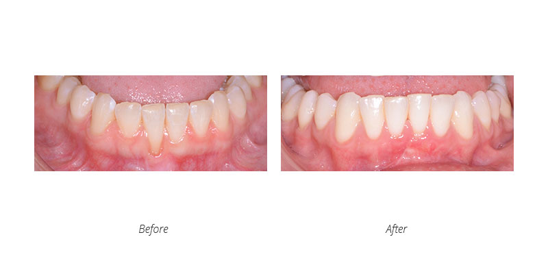 periodontal connective tissue graft