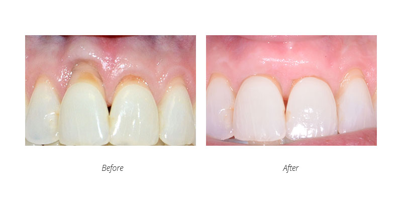 periodontal connective tissue graft