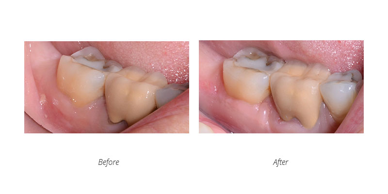 periodontal connective tissue graft