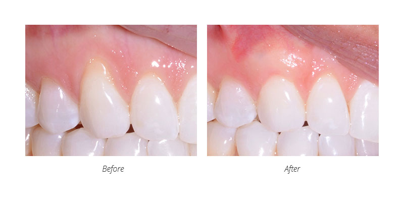 periodontal connective tissue graft